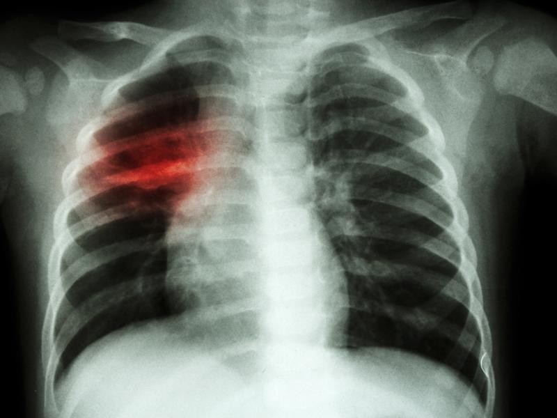 EMBOLIA PULMONAR: O QUE É A EMBOLIA PULMONAR