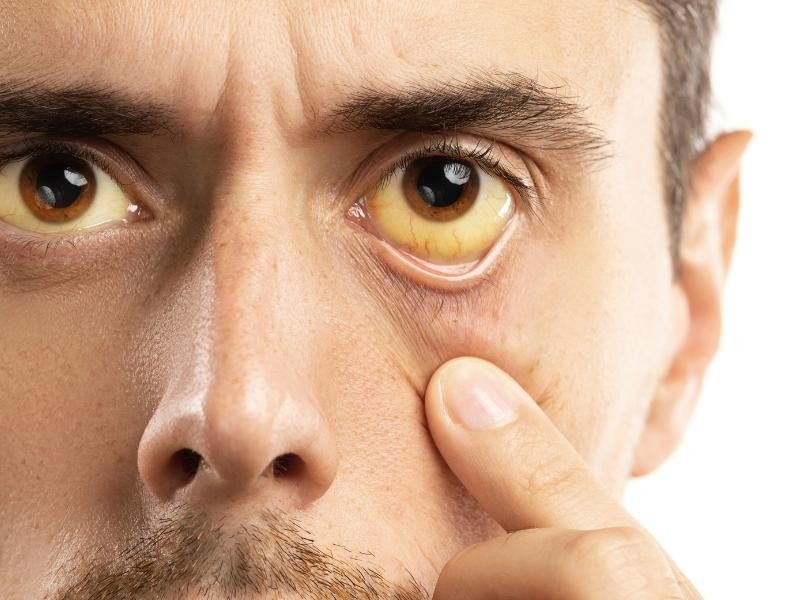 Pele Amarelada é Sinal de Câncer no Pâncreas? Conheça os Sinais da Doença