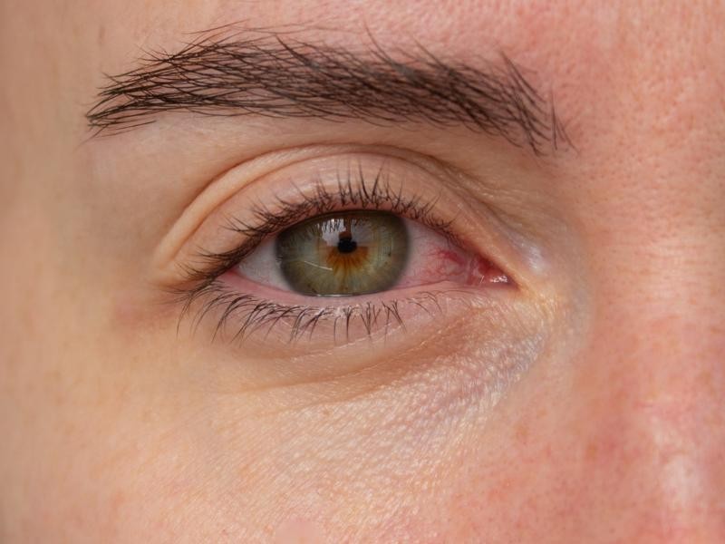 Infecção Ocular por Citomegalovírus: Quando o Vírus Afeta a Visão