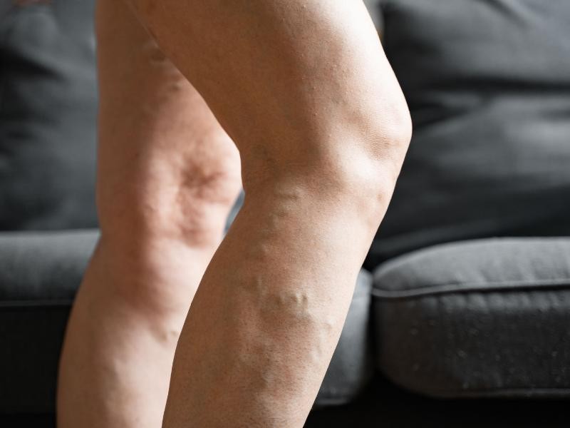 Pernas cansadas, inchadas ou com veias aparentes? Saiba quando procurar um angiologista?