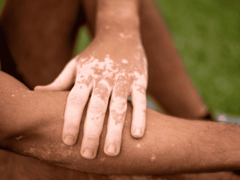 Vitiligo: Causas, Evolução da Doença e Opções de Tratamento