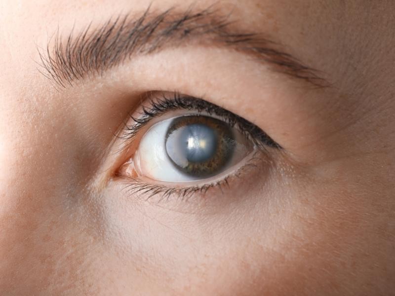 Como a cirurgia de catarata pode melhorar a visão e quem pode se beneficiar dela?